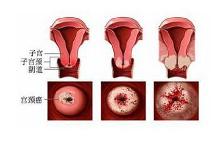 宫颈癌早期筛查多久